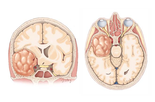 Neuro