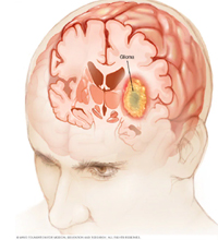 Tumor